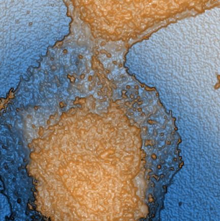 Lung_cancer_cell.JPG